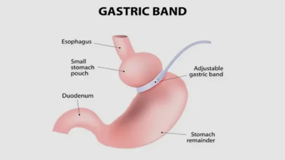 gastric band surgery cost turkey