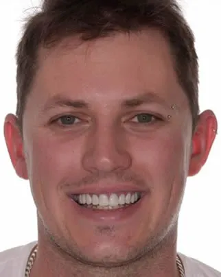 hollywood smile after