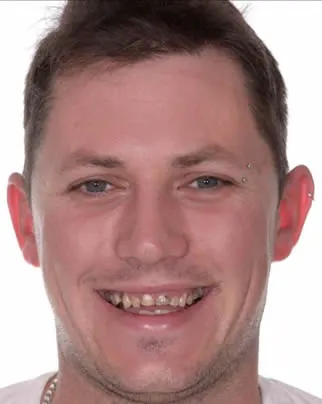 hollywood smile before hollywood smile before