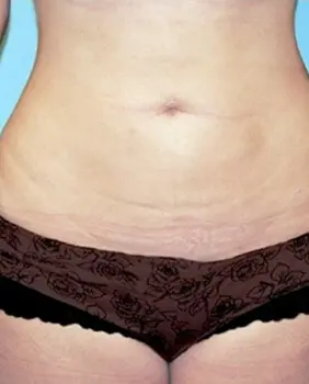 liposuction surgery after