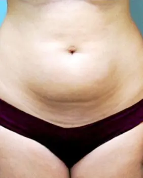 liposuction surgery before liposuction surgery before