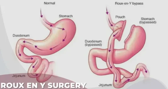 roux en y gastric bypass surgery