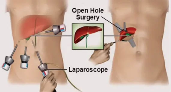 laparoscopic-surgery-cost-in-turkey