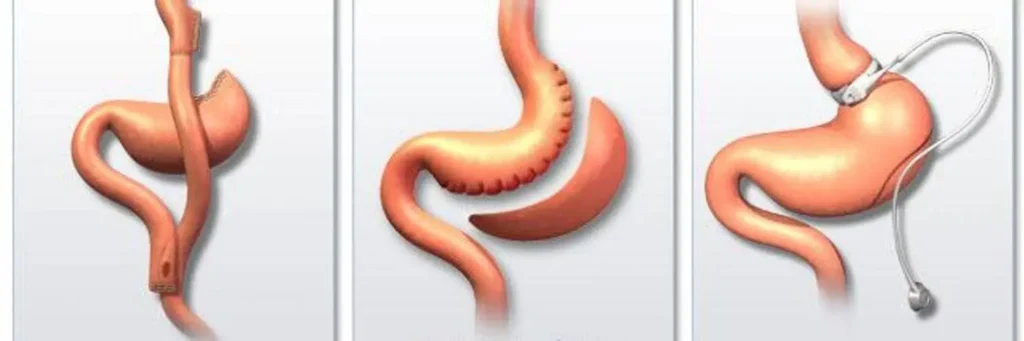 what is gastric band surgery