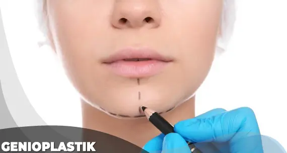Genioplastik Kosten Ab Tuerkei Istanbul